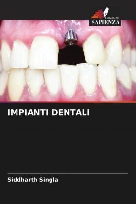 IMPIANTI DENTALI