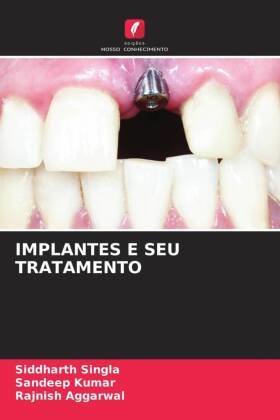 IMPLANTES E SEU TRATAMENTO