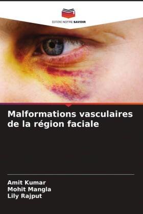 Malformations vasculaires de la région faciale