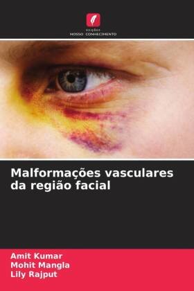 Malformações vasculares da região facial